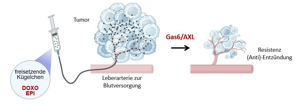 AXL Signalweg bei der TACE-Behandlung des hepatozellulären Karzinoms