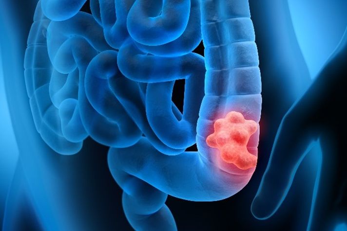 Colorectal cancer